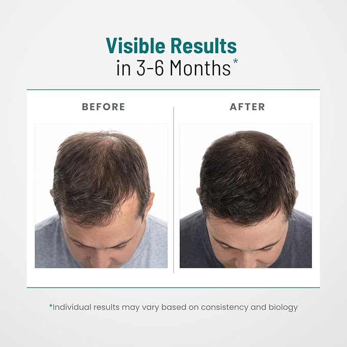 DHT Blocker for Men | Ultra Potent Hair Growth Formula | Saw Palmetto Biotin Pumpkin Seed Herbal Extracts | Natural Hair Loss Supplements | Hair Regrowth Vitamins | Made in The USA | 90 Capsules