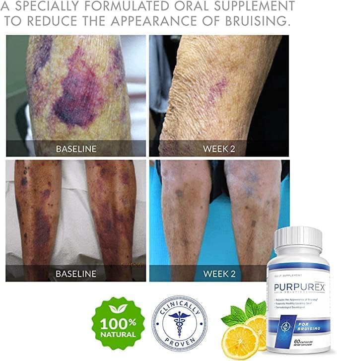 Dietary Supplement for Bruising (30-Day Supply)