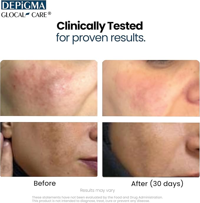 GlocalCare Depigma Support Reduction of Hyperpigmentation Melasma &amp Dark Spots with Glutathione Polypodium Leucotomos Grape Seed &amp Marigold Extract